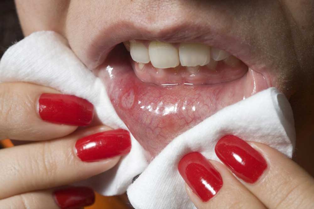 Mouth Cancer – Causes and Symptoms