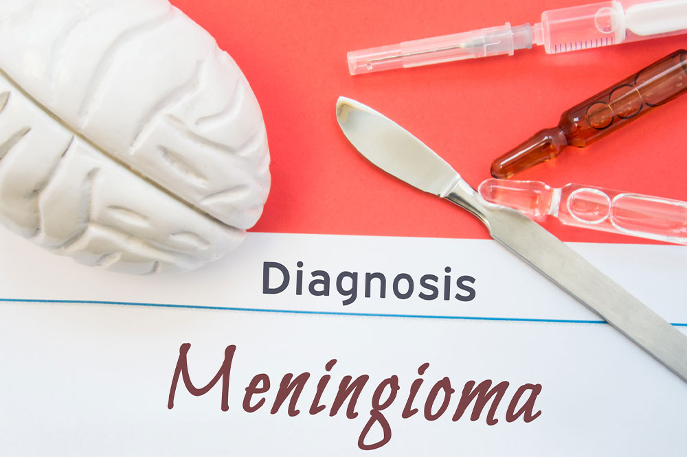 Meningioma – Symptoms, Causes, Diagnosis, and More
